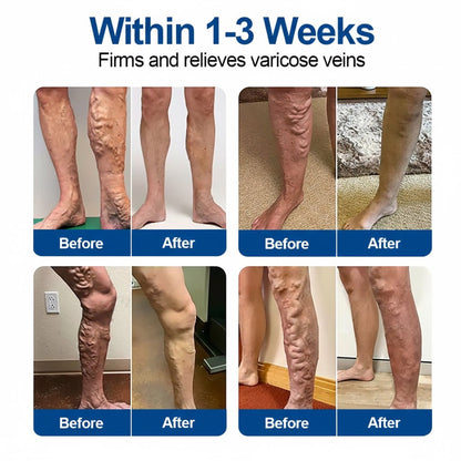 IE👨‍⚕️✅ Natravor® VeinEase Microneedle Care Patch ⚡ Fast Comfort, Lasting Leg Support